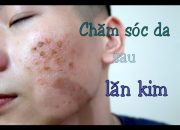 CHĂM SÓC DA SAU LĂN KIM – CẬP NHẬT NGÀY THỨ 5 || #VLOG6 || DYLAN NGUYEN