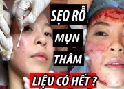 Cùng Vi thực hiện phương pháp lăn kim PRP "ma cà rồng" ? Review chân thật tất tần tật