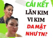 Sau Khi Lăn kim Vi Kim Peel da mặt Như thế Nào ? Ngày #1