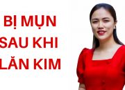 TẠI SAO BỊ NỔI MỤN SAU KHI LĂN KIM – BỊ MỤN ĐẦU TRẮNG SAU KHI LĂN KIM –  CÓ NÊN LĂN KIM TRỊ MỤN