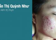 [2017] "RÙNG MÌNH" với kết quả sau lăn kim ở Taza Spa